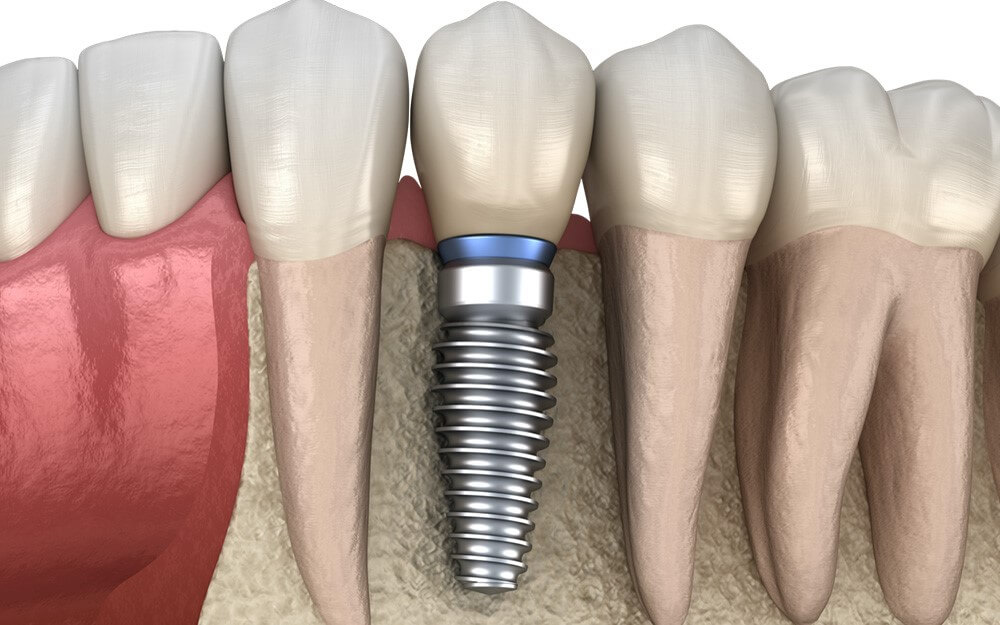 SS_PX_Implantat
